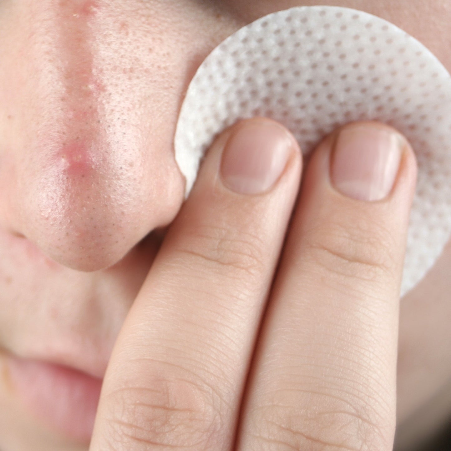 Close-up of a person using a cleansing pad on blemished skin.