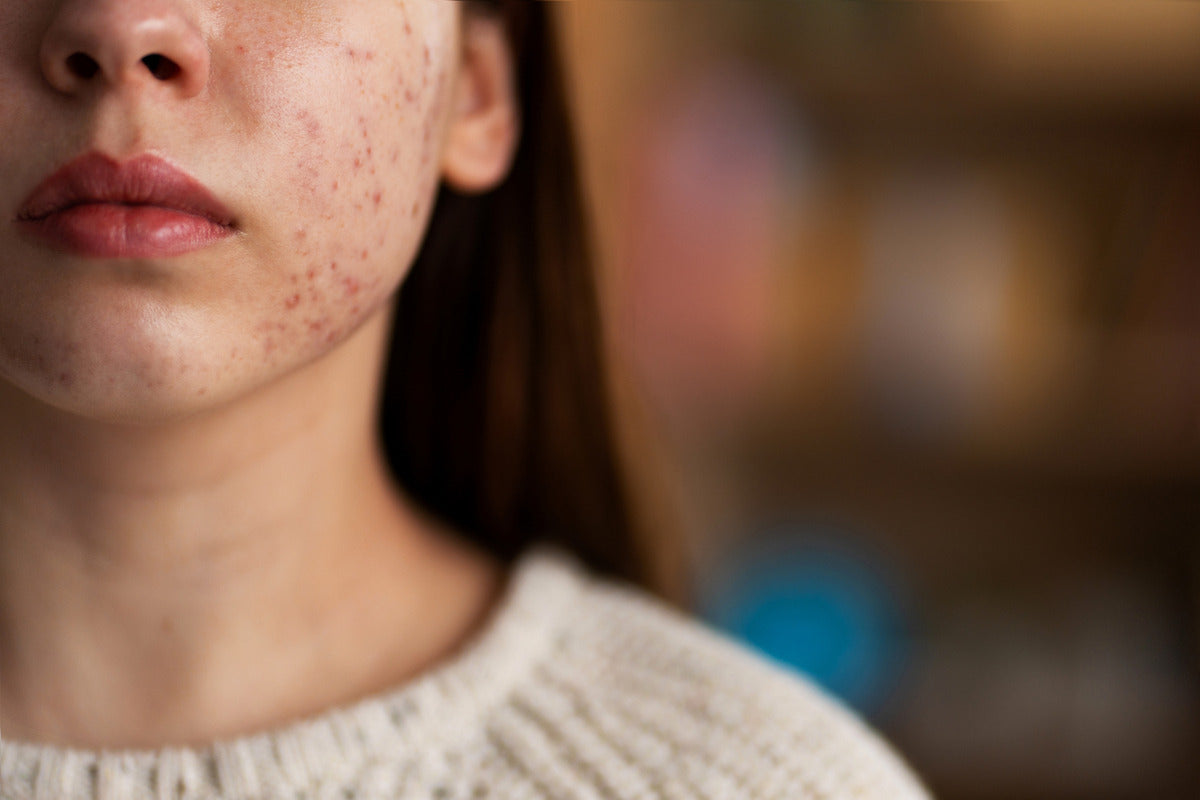 Close-up of a young person’s lower face showing visible red acne breakouts on the cheeks and jawline.